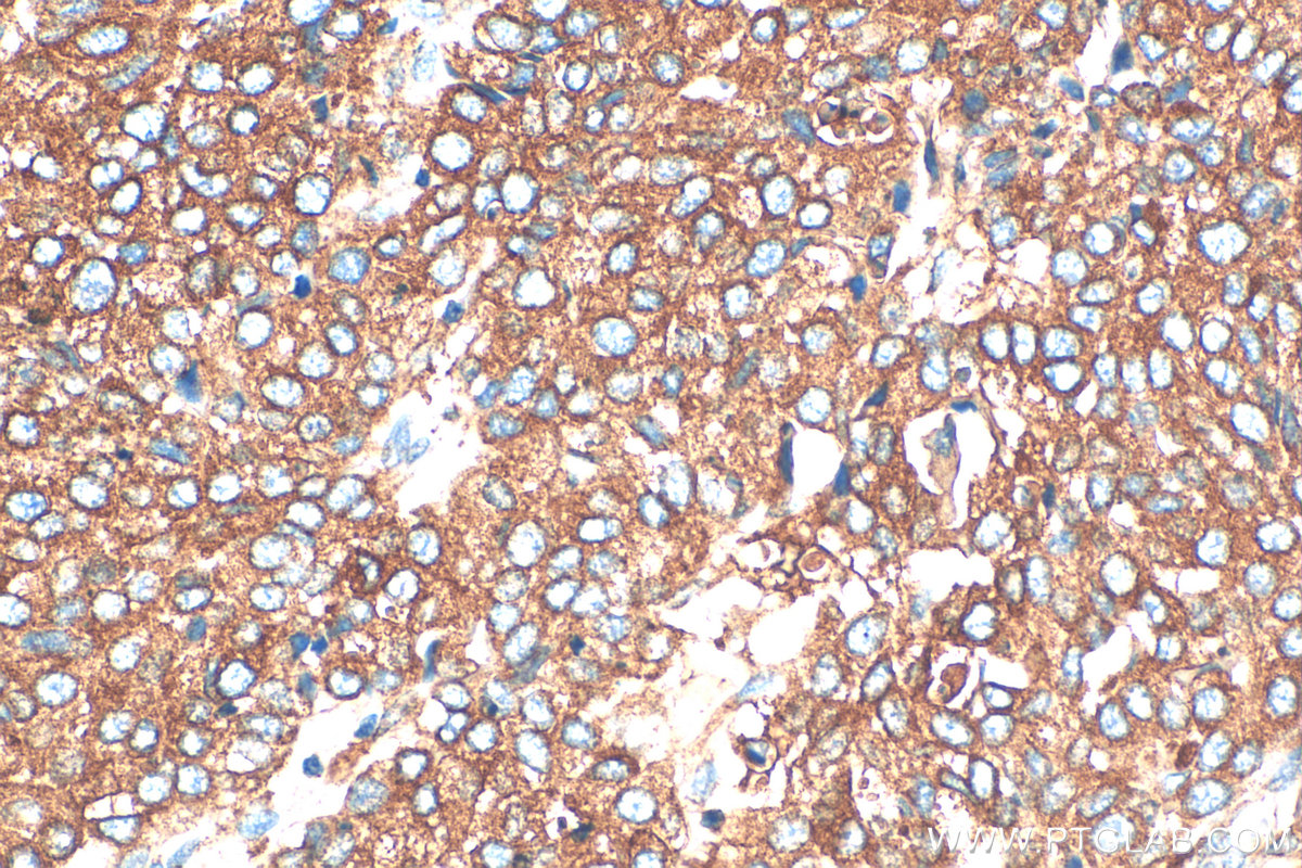 IHC staining of human stomach cancer using 33113-1-AP (same clone as 33113-1-PBS)