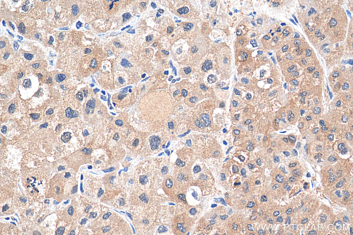 IHC staining of human liver cancer using 10656-1-AP