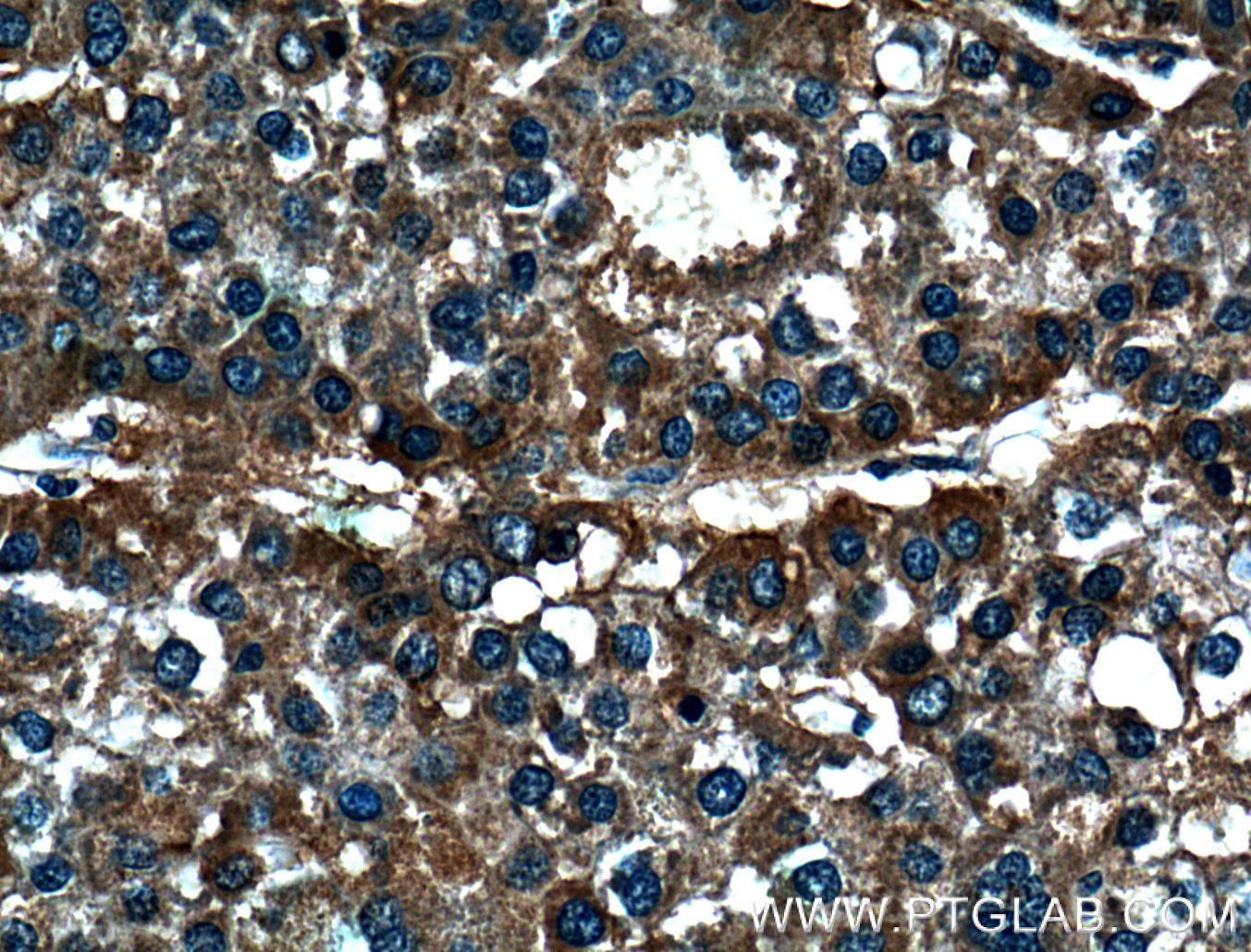 IHC staining of human liver cancer using 20985-1-AP