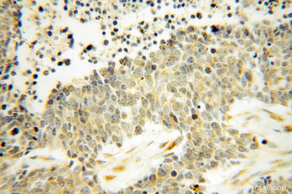 IHC staining of human lung cancer using 14811-1-AP