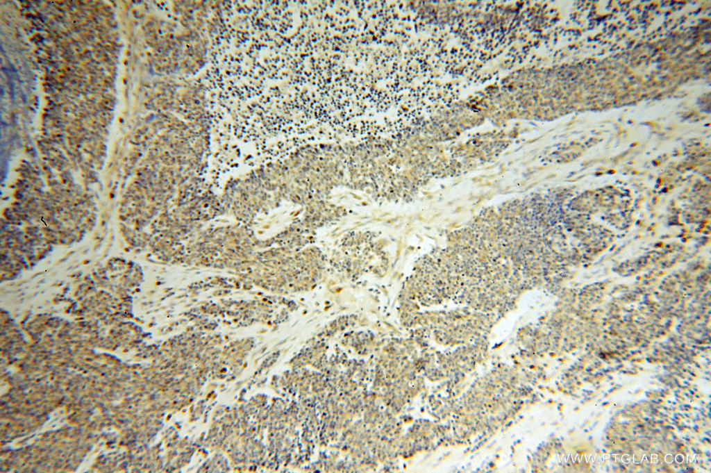 IHC staining of human lung cancer using 14811-1-AP