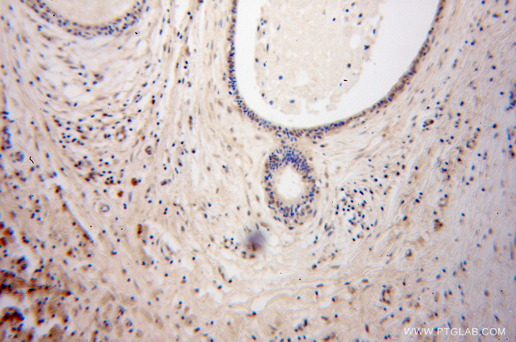 IHC staining of human breast cancer using 10996-1-AP