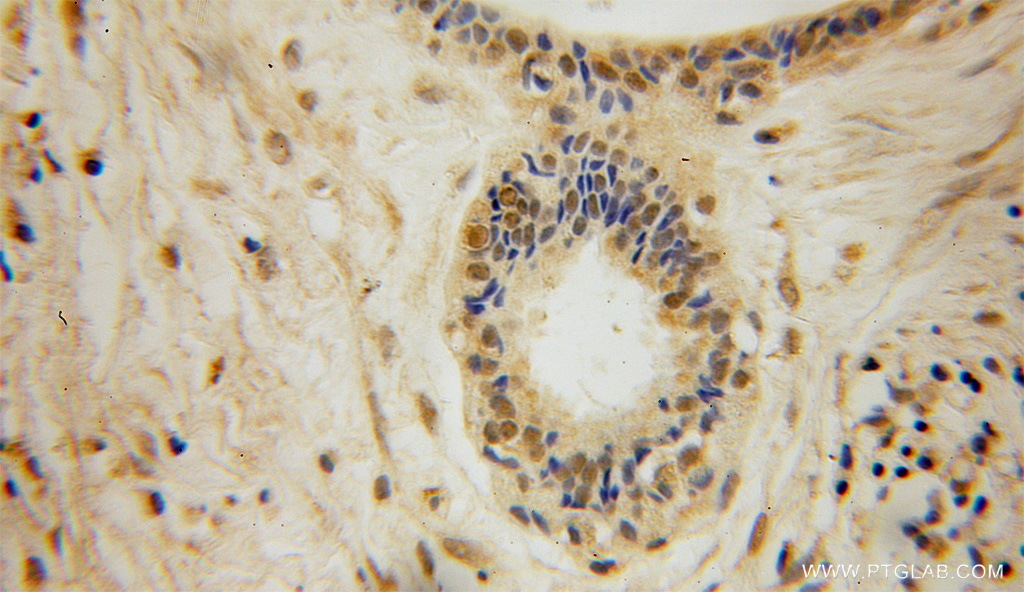 IHC staining of human breast cancer using 10996-1-AP