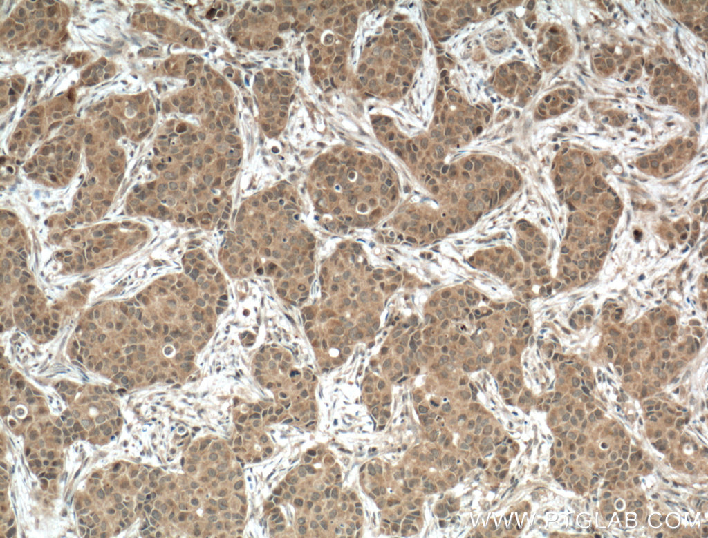 IHC staining of human breast cancer using 24320-1-AP