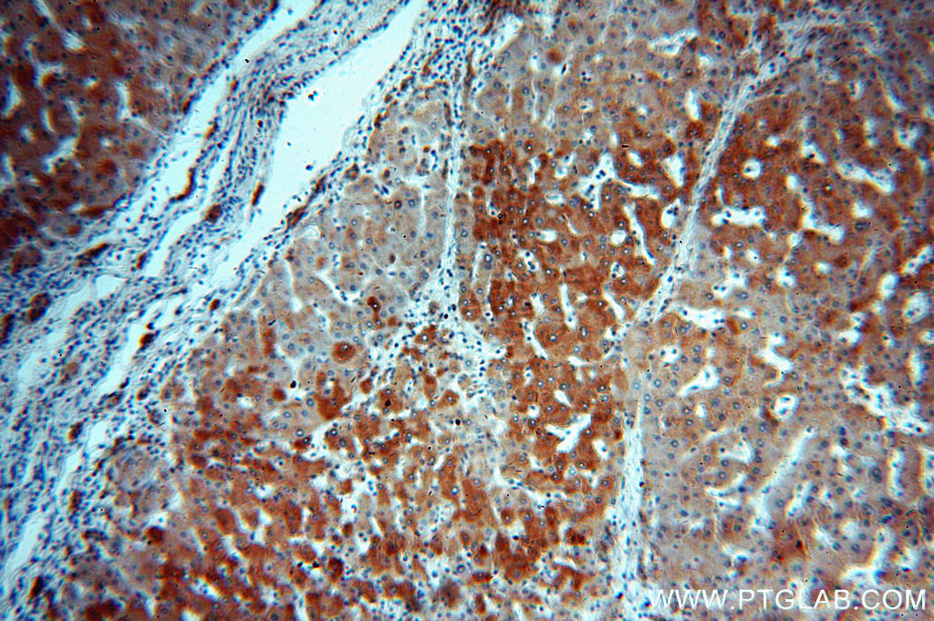 IHC staining of human hepatocirrhosis using 16314-1-AP