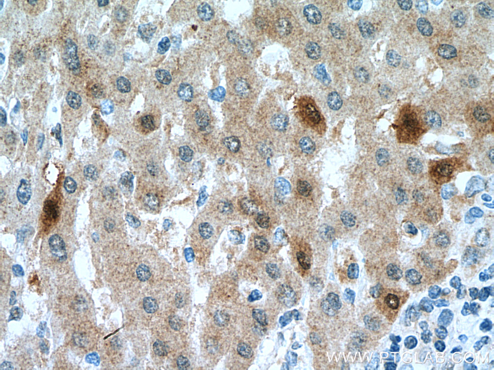 IHC staining of human liver cancer using 15194-1-AP