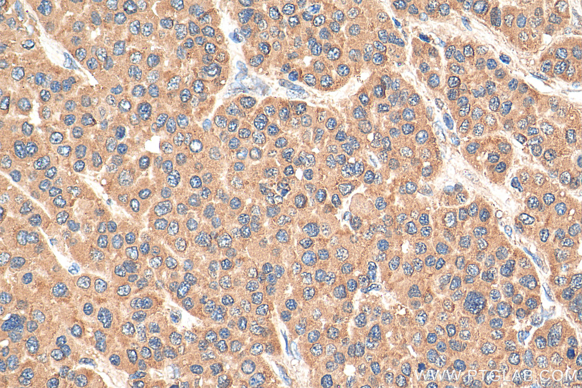 IHC staining of human liver cancer using 81021-1-RR (same clone as 81021-1-PBS)