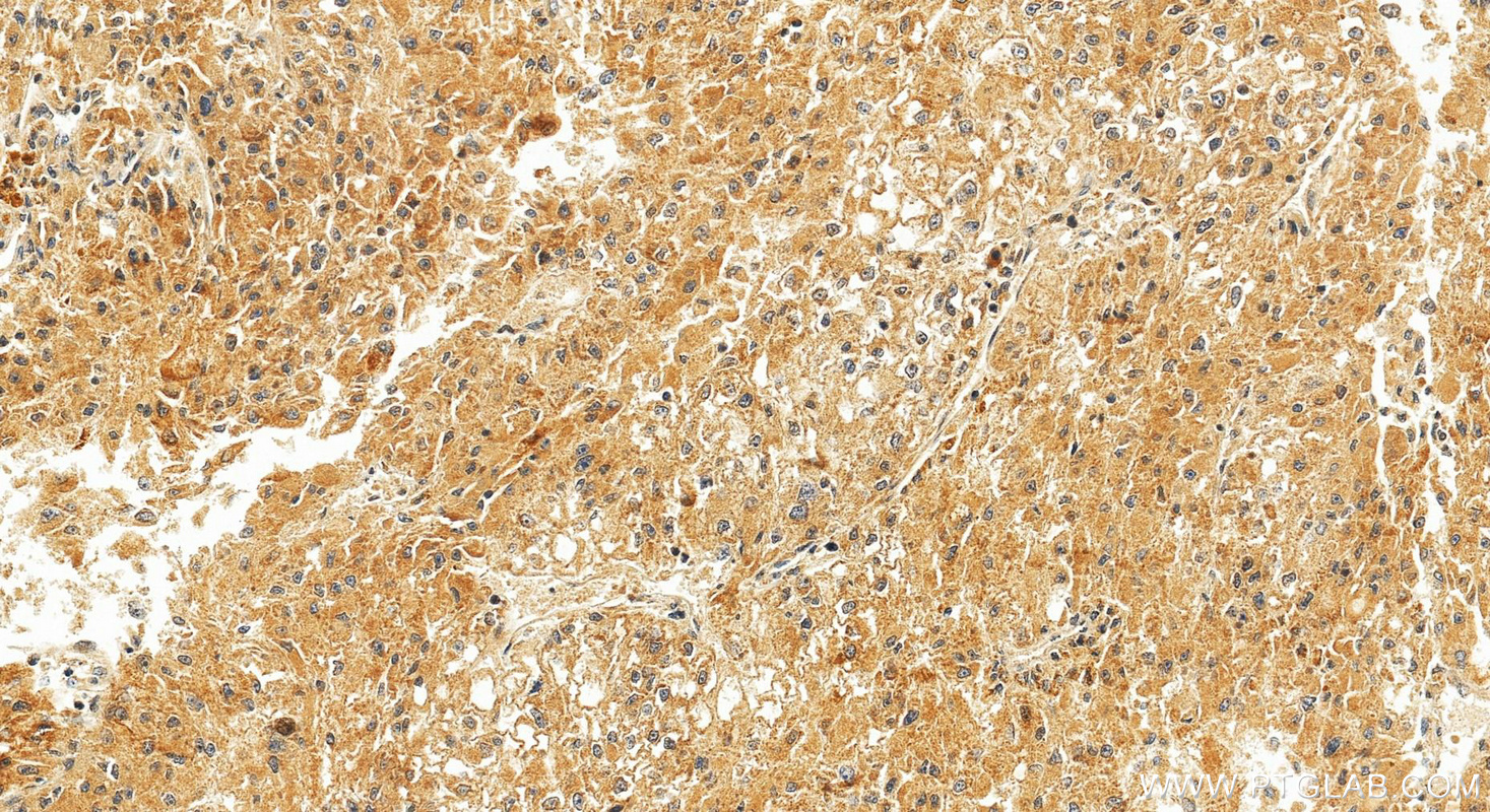 IHC staining of Hepatocellular carcinoma using RMX00088