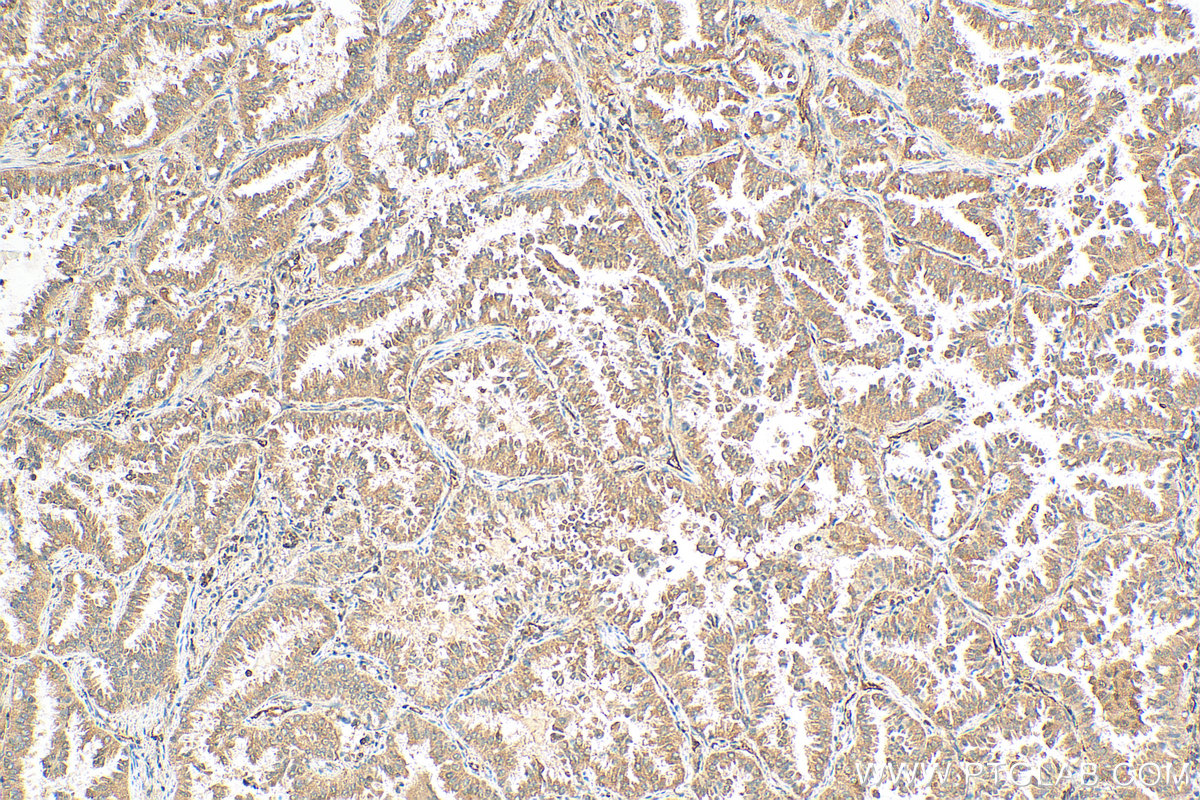 IHC staining of human lung cancer using 27493-1-AP