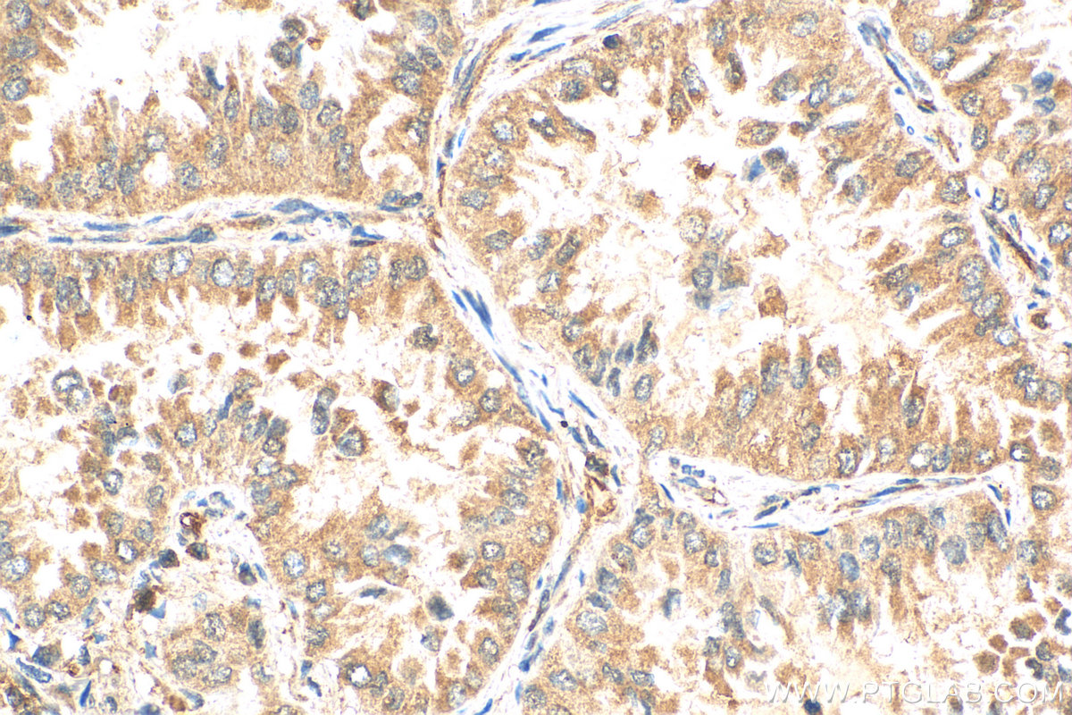 IHC staining of human lung cancer using 27493-1-AP