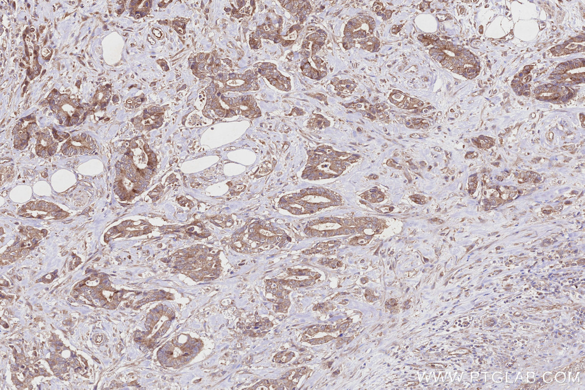 IHC staining of human rectal cancer using 27493-1-AP