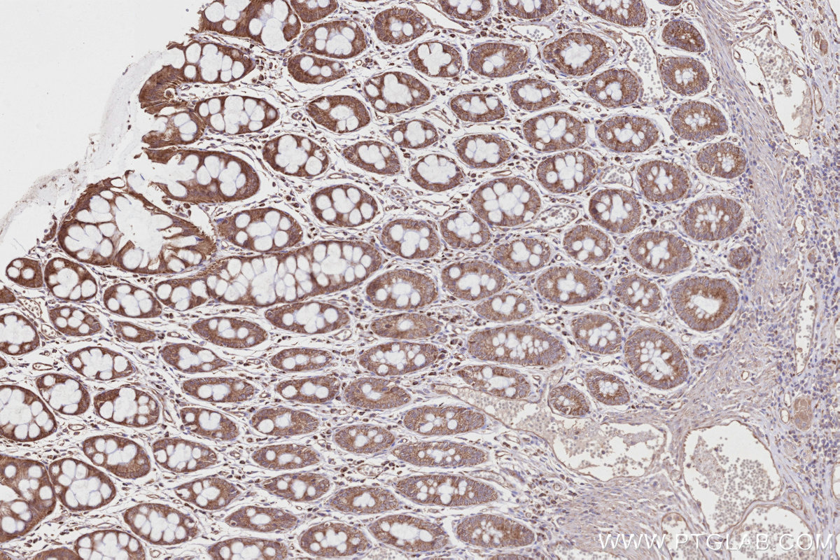 IHC staining of human rectal cancer using 27493-1-AP