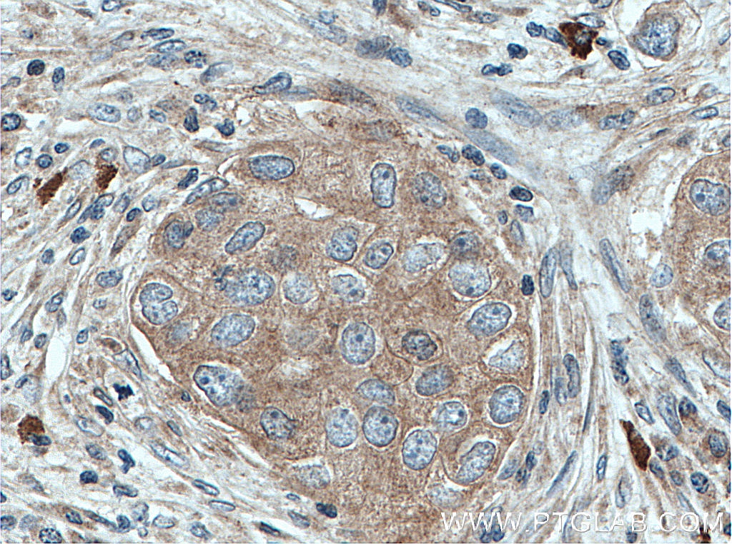 IHC staining of human breast cancer using 11355-1-AP