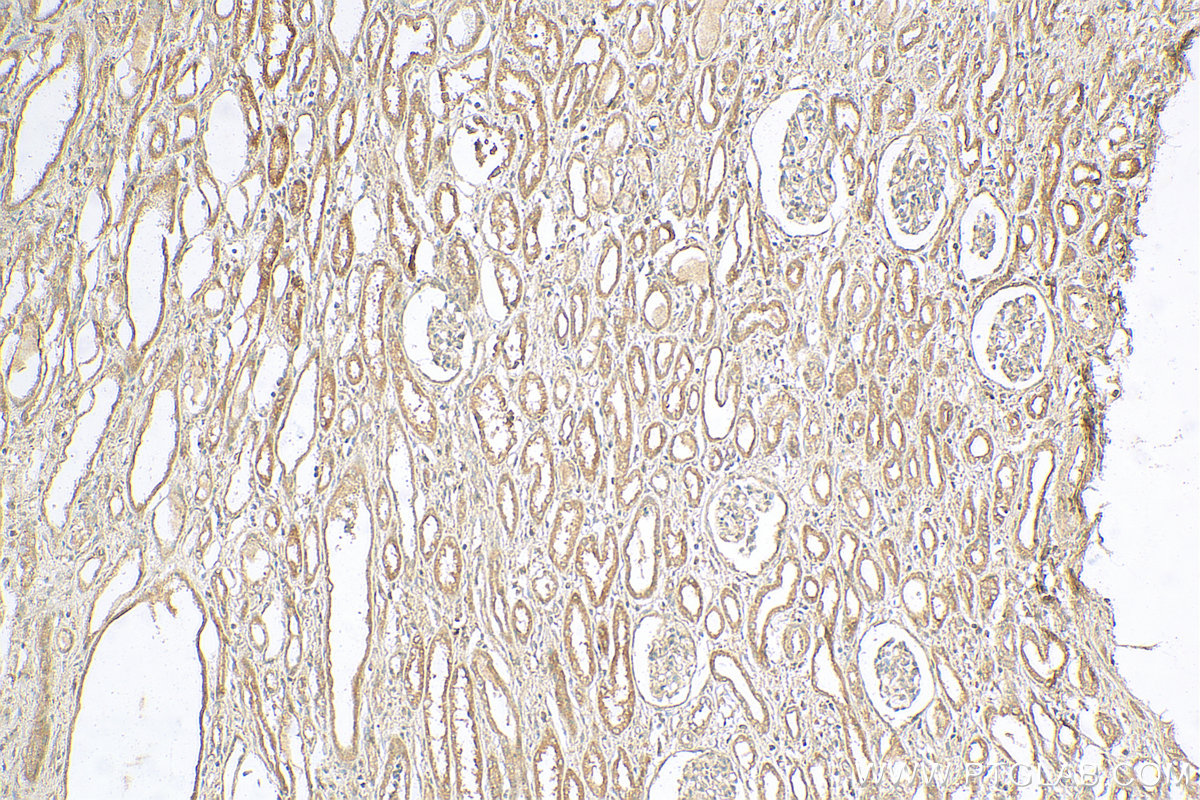 IHC staining of human nephroblastoma using 11355-1-AP