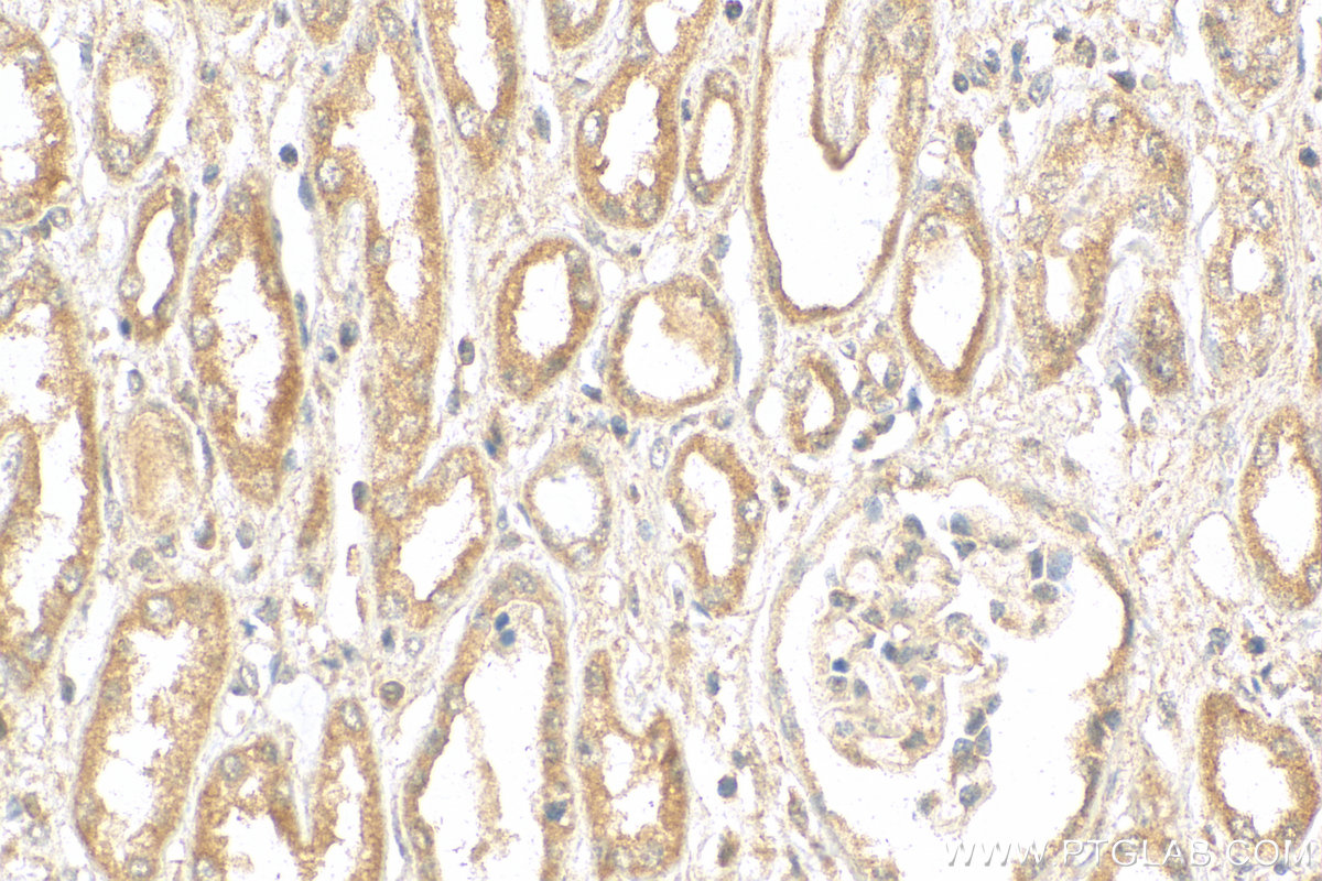 IHC staining of human nephroblastoma using 11355-1-AP