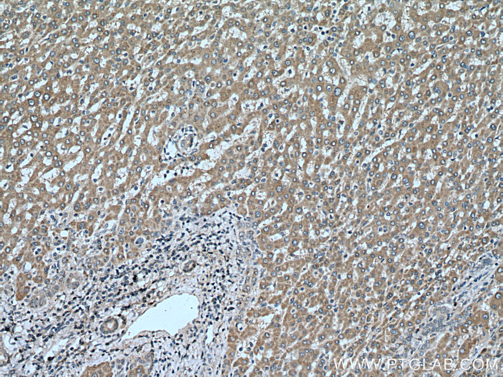 IHC staining of human liver cancer using 11790-1-AP