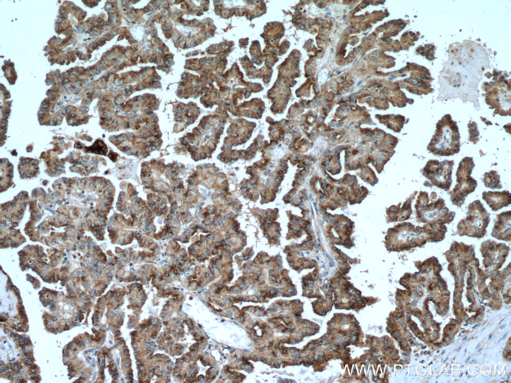 IHC staining of human thyroid cancer using 66813-1-Ig