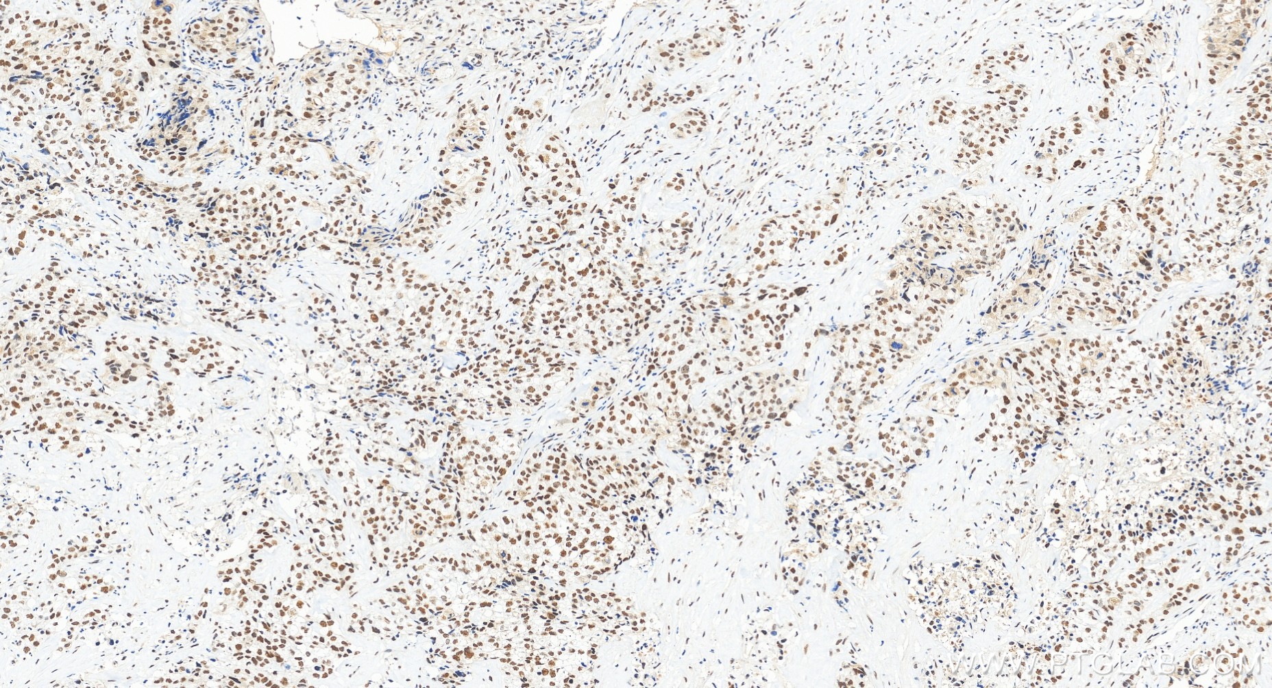 Immunohistochemical analysis of paraffin-embedded human ovary cancer tissue slide using 85705-2-RR (DIS3 antibody) at dilution of 1:500 (under 20x lens). Heat mediated antigen retrieval with Tris-EDTA buffer (pH 9.0). IHC staining of human ovary cancer using 85705-2-RR
