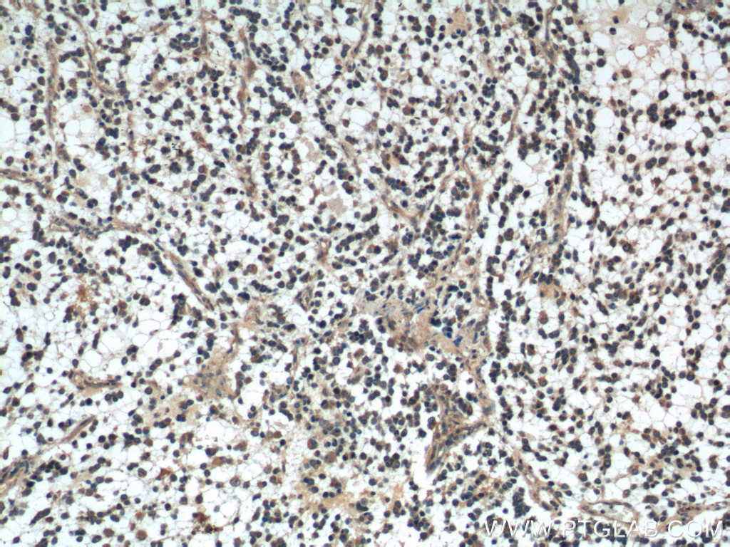IHC staining of human gliomas using 21112-1-AP