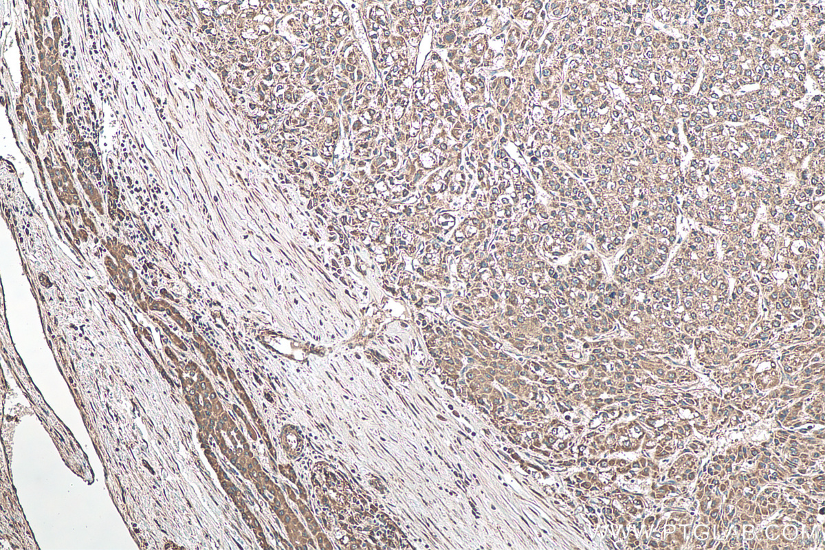 IHC staining of human liver cancer using 10365-1-AP