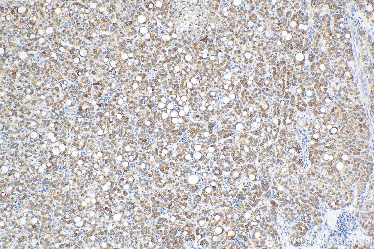 IHC staining of human liver cancer using 68303-1-Ig