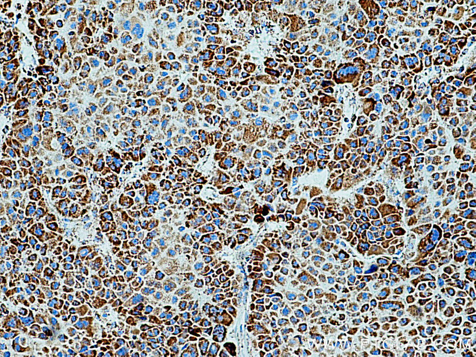 IHC staining of human liver cancer using 16431-1-AP