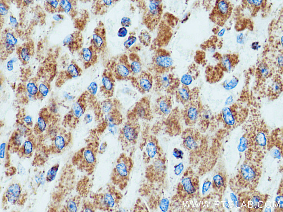 IHC staining of human liver cancer using 16431-1-AP