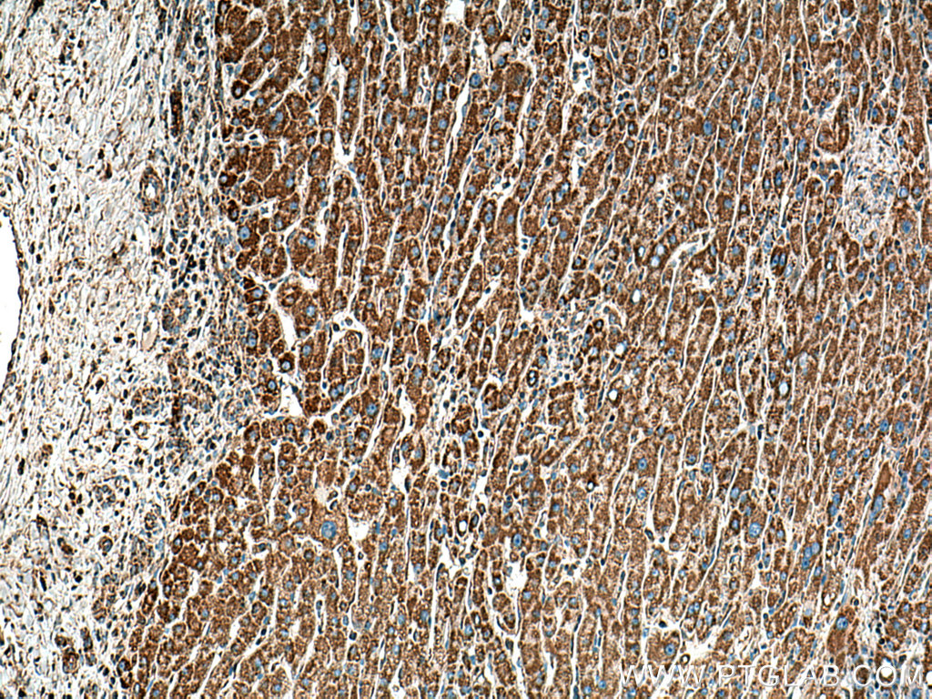 IHC staining of human liver cancer using 67702-1-Ig