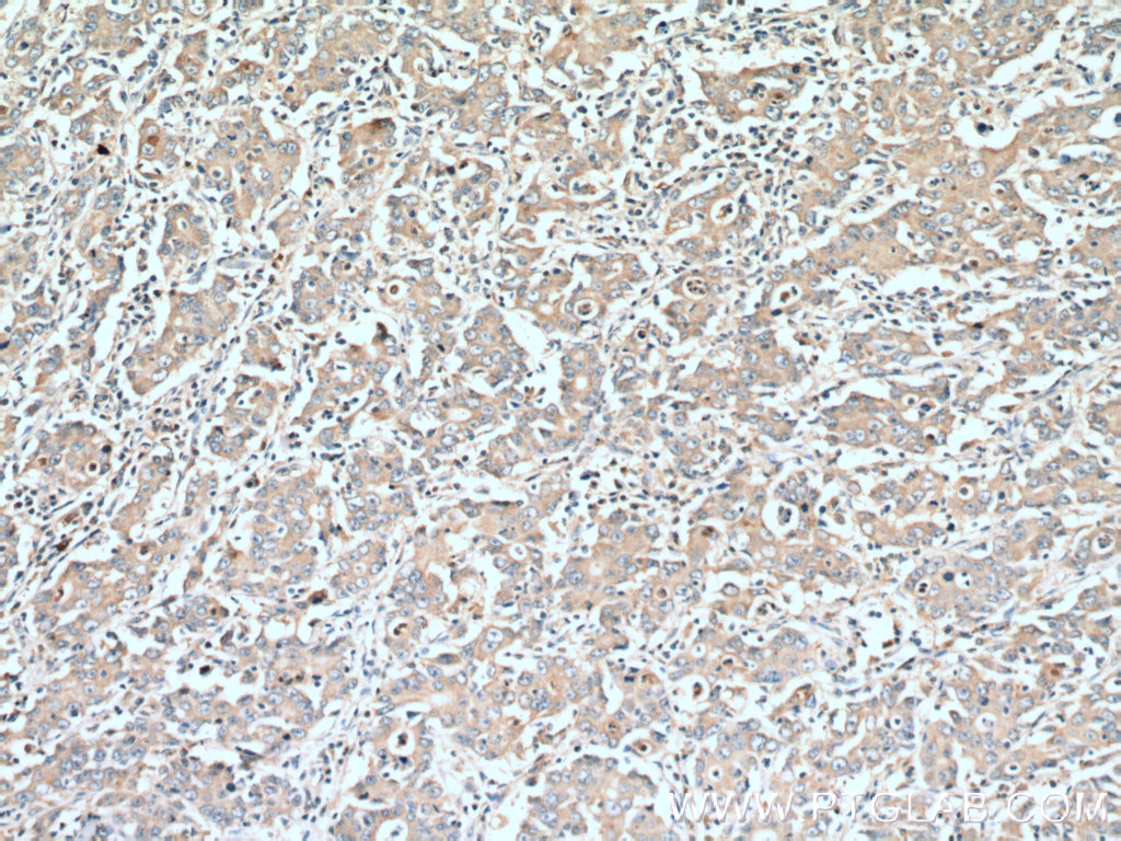 IHC staining of human stomach cancer using 27069-1-AP