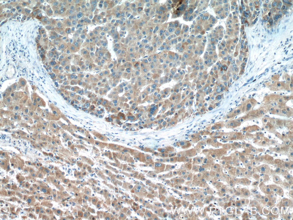 IHC staining of human liver cancer using 24813-1-AP