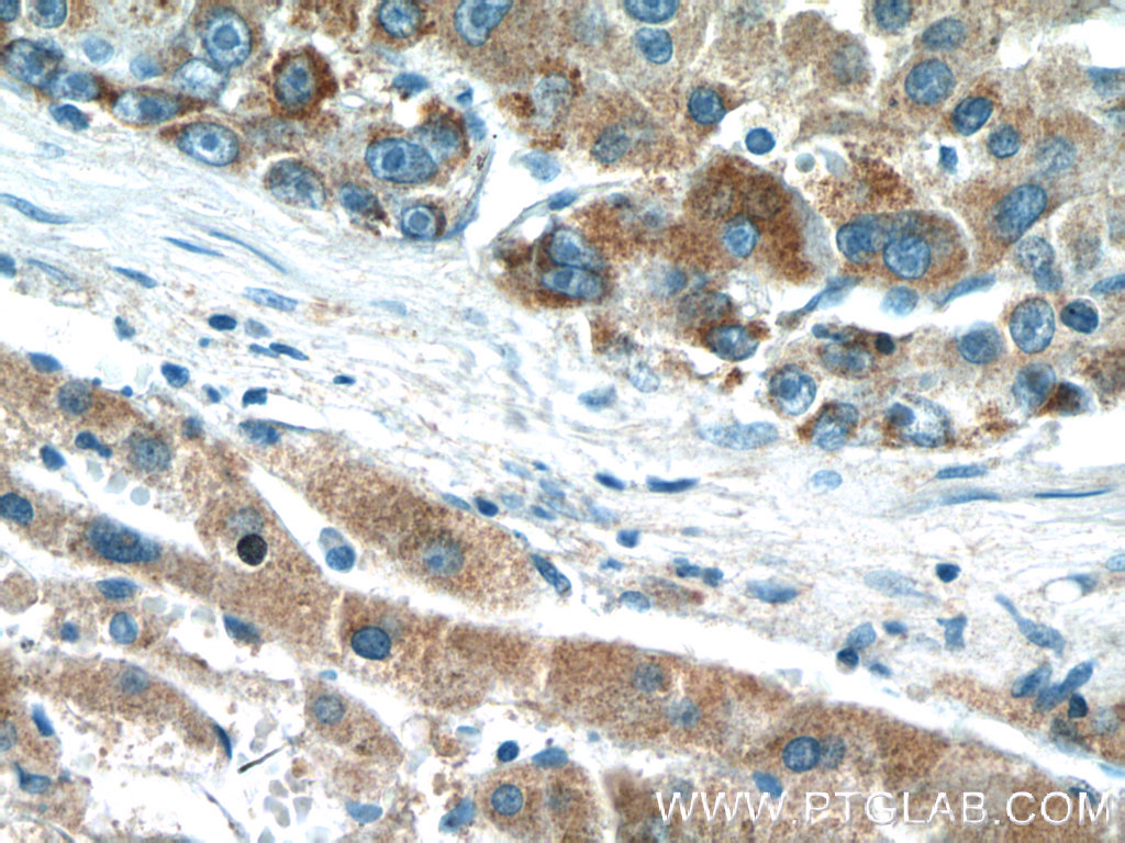 IHC staining of human liver cancer using 24813-1-AP