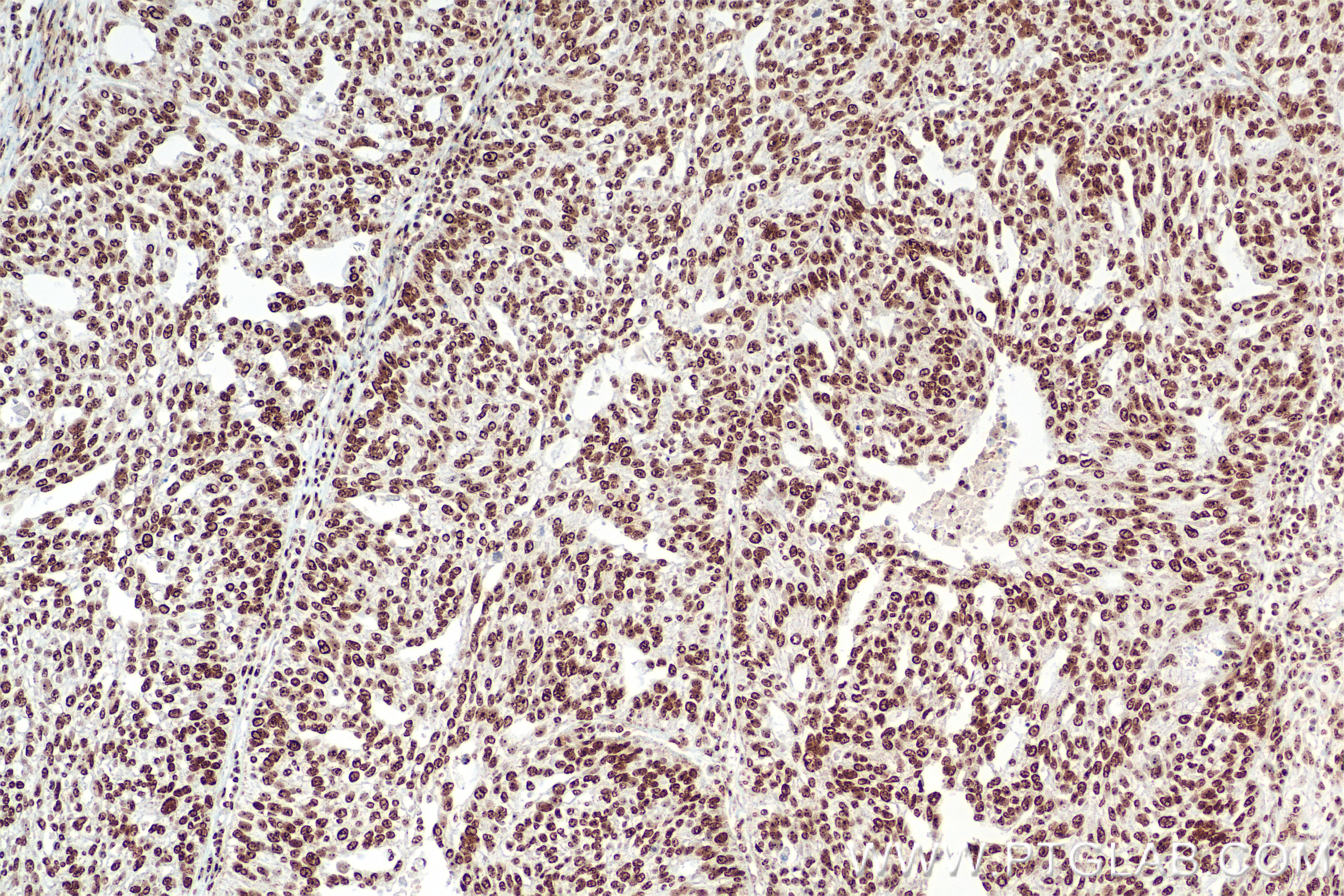IHC staining of human ovary tumor using 85855-1-RR