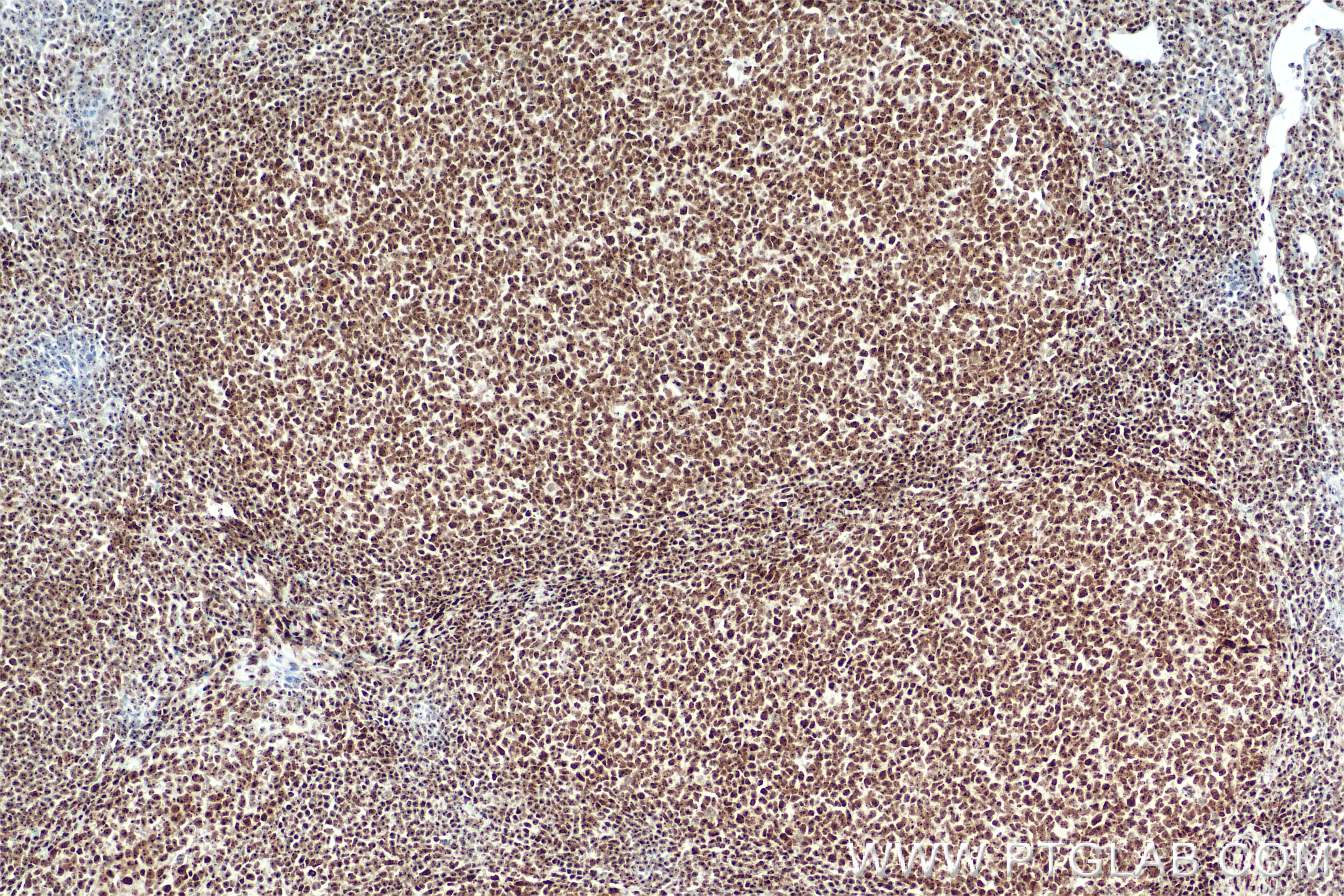 IHC staining of human tonsillitis using 85855-1-RR