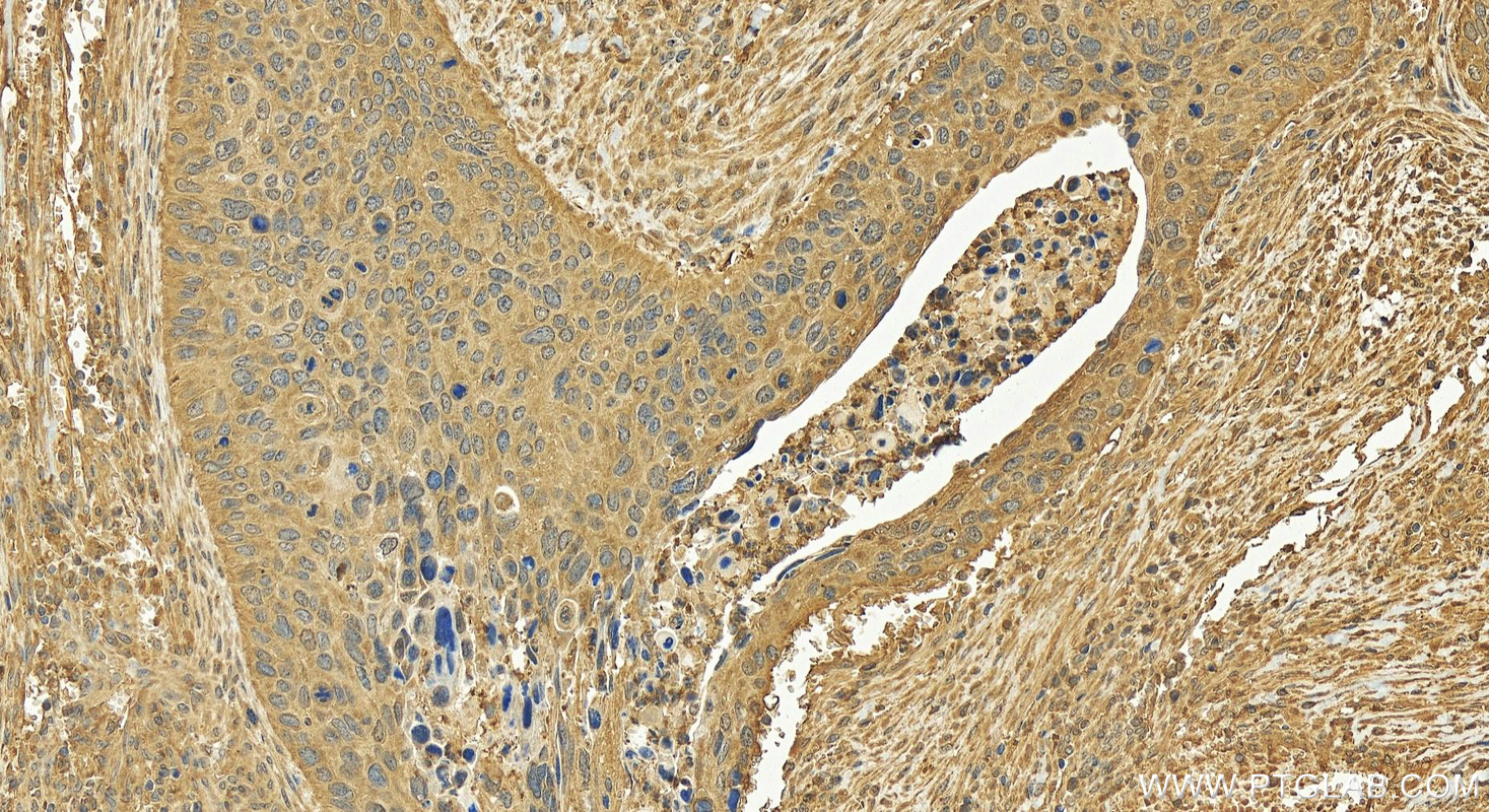 IHC staining of human cervical cancer using 18727-1-AP