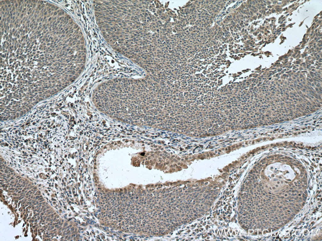 IHC staining of human cervical cancer using 18727-1-AP