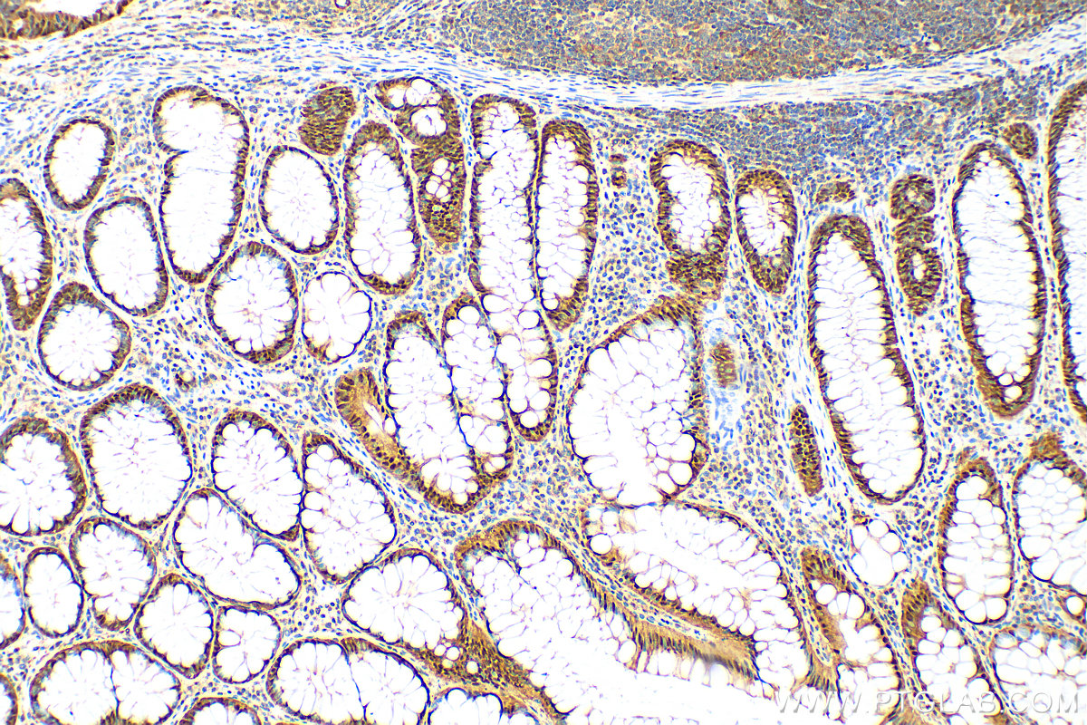 IHC staining of human colon cancer using 82676-1-RR