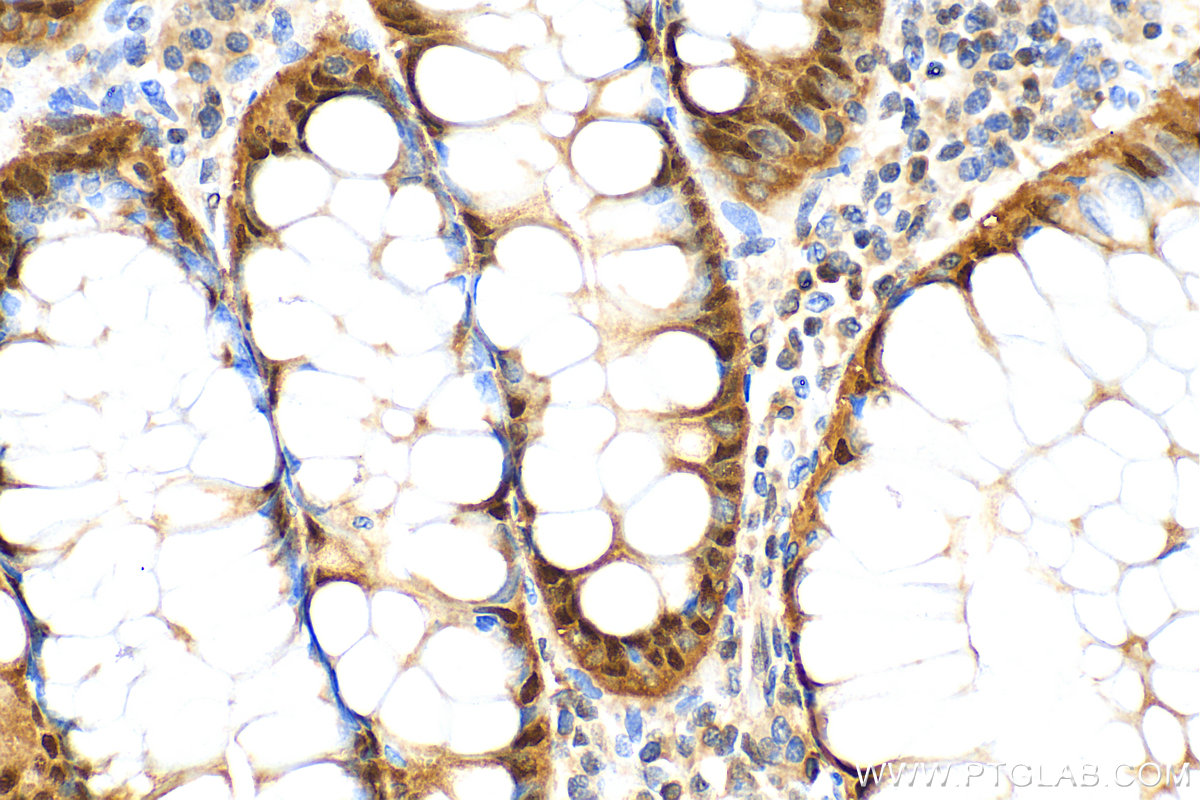 IHC staining of human colon cancer using 82676-1-RR (same clone as 82676-1-PBS)