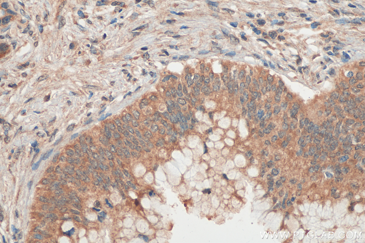 IHC staining of human pancreas cancer using 67966-1-Ig