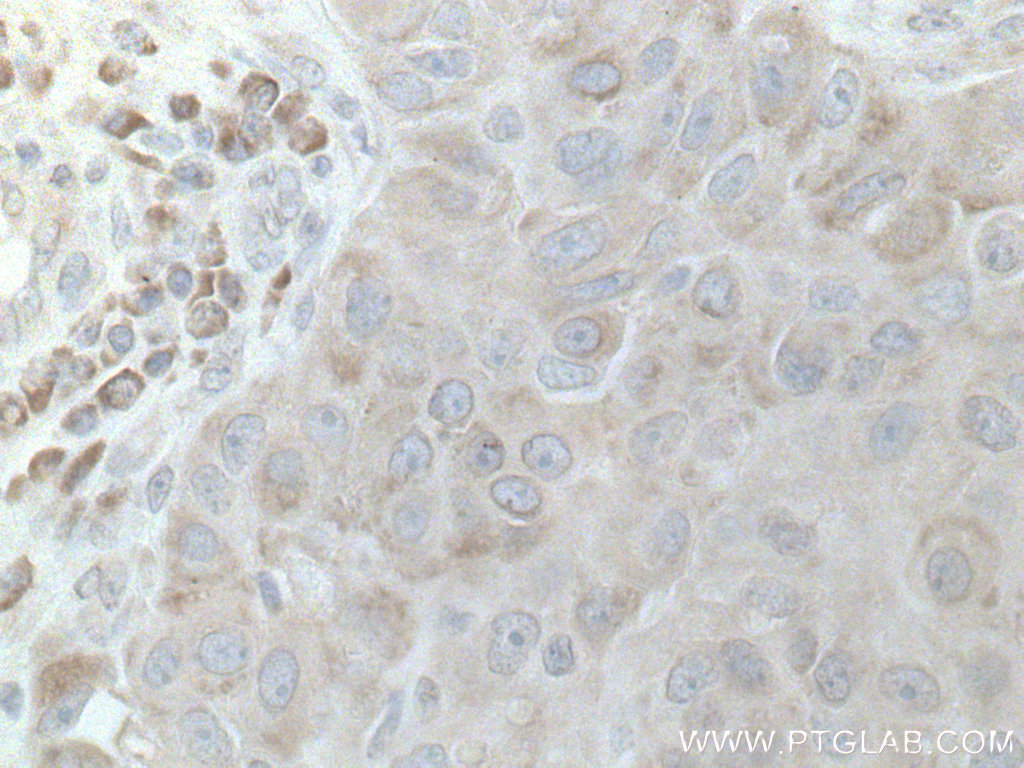 IHC staining of human breast cancer using 12362-1-AP