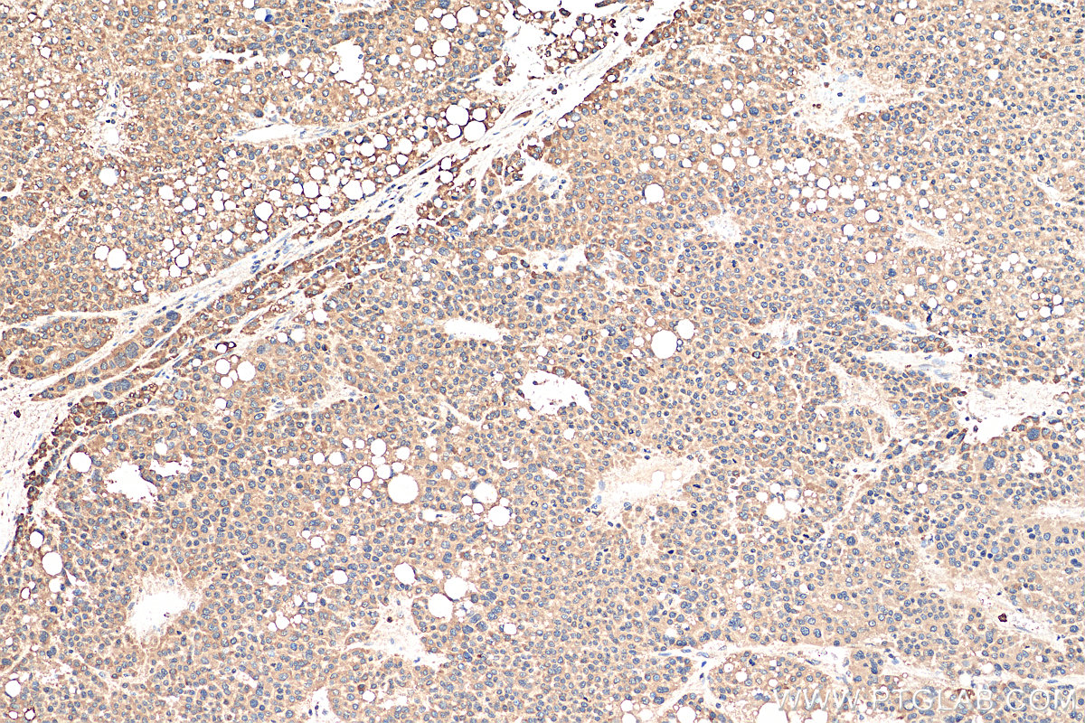 IHC staining of human liver cancer using 12362-1-AP