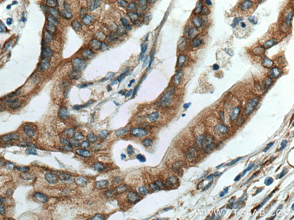 IHC staining of human pancreas cancer using 13101-1-AP