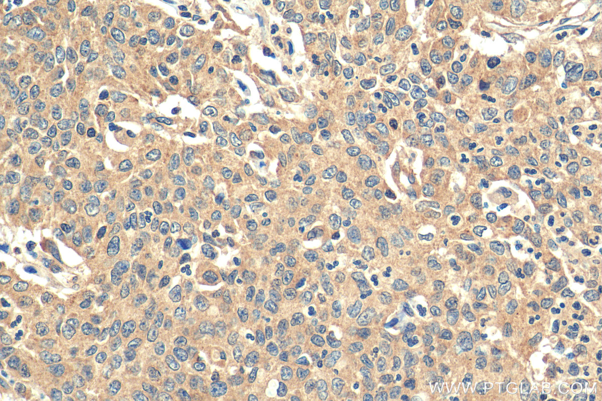 IHC staining of human stomach cancer using 12338-1-AP