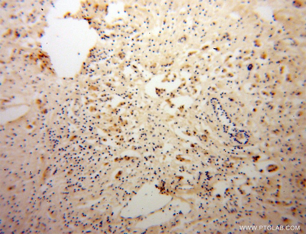 IHC staining of human breast cancer using 13853-1-AP