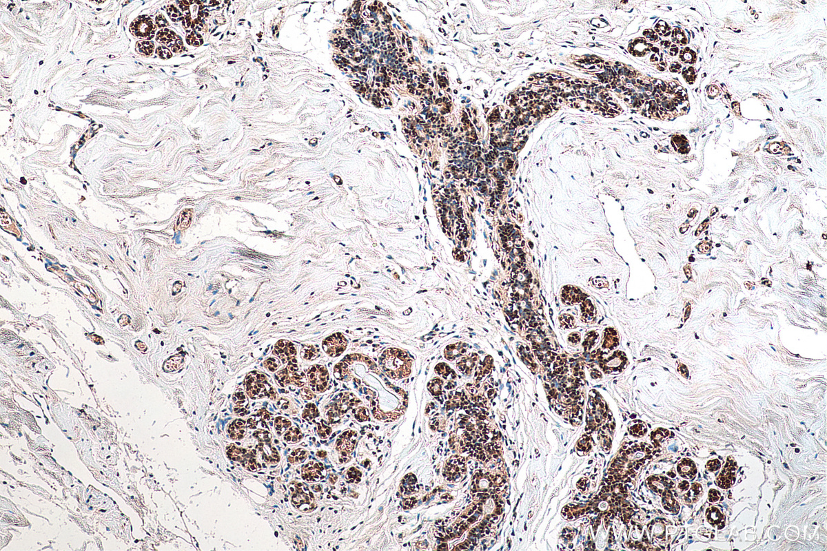 IHC staining of human breast cancer using 25444-1-AP