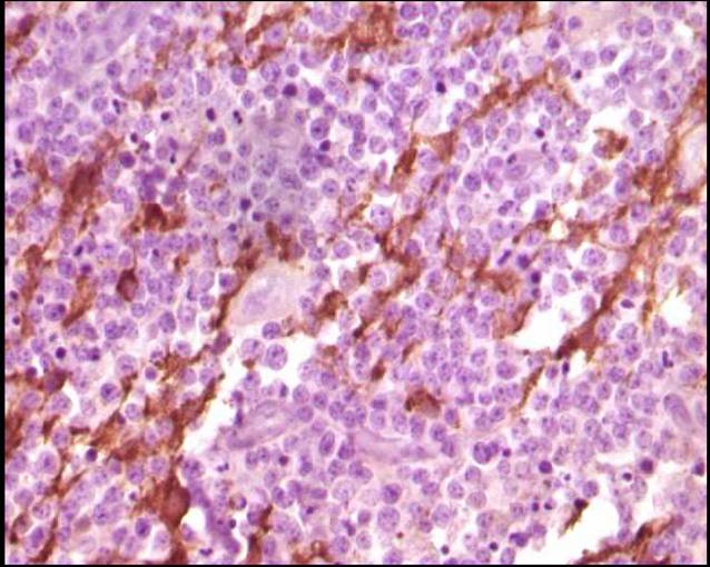 IHC staining of Gliomas using 65027-1-Ig