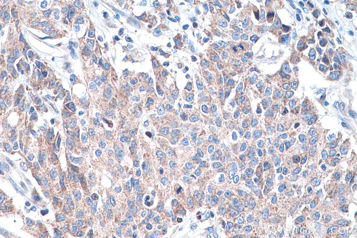 IHC staining of human stomach cancer using 20954-1-AP