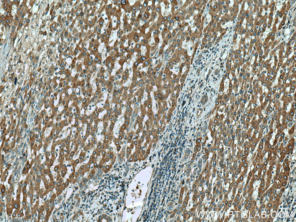 IHC staining of human liver cancer using 66969-1-Ig