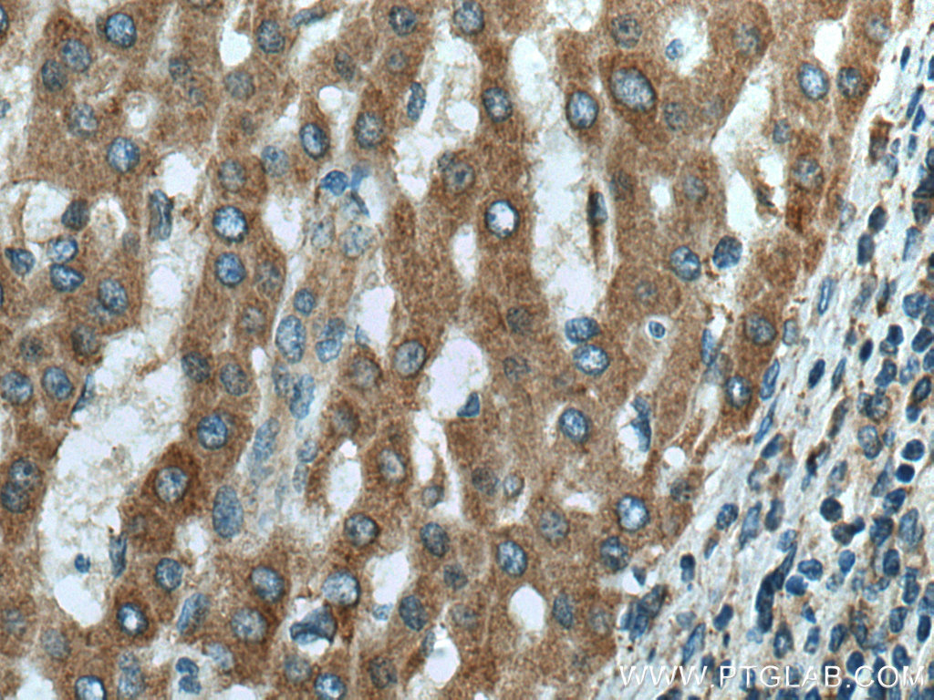 IHC staining of human liver cancer using 66969-1-Ig