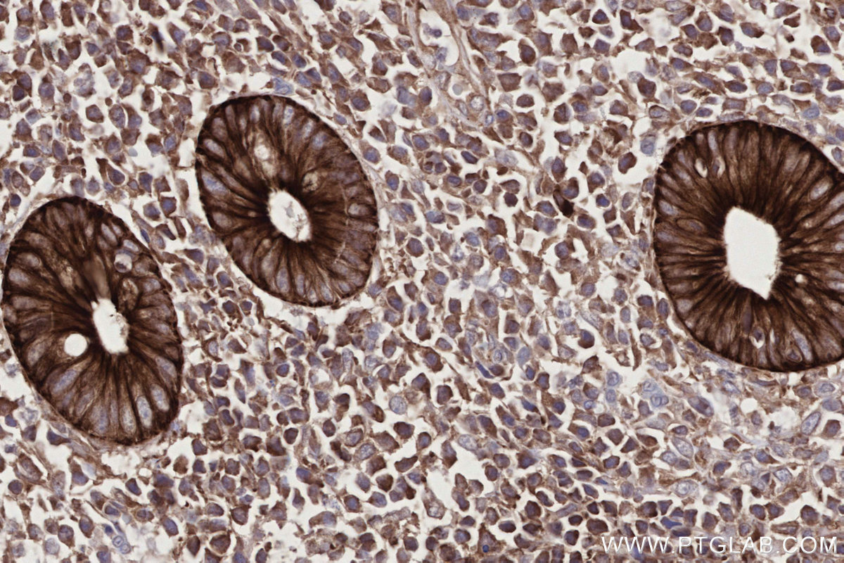IHC staining of human appendicitis using 66969-1-Ig IHC staining of human appendicitis using 66969-1-Ig
