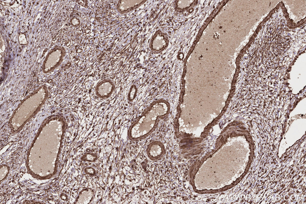 IHC staining of human ovary cancer using 20683-1-AP IHC staining of human ovary cancer using 20683-1-AP